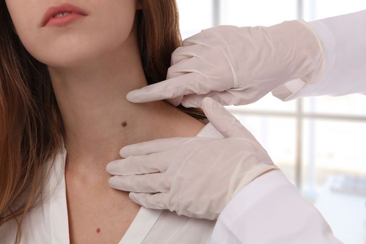 Skin Tag Removal Training