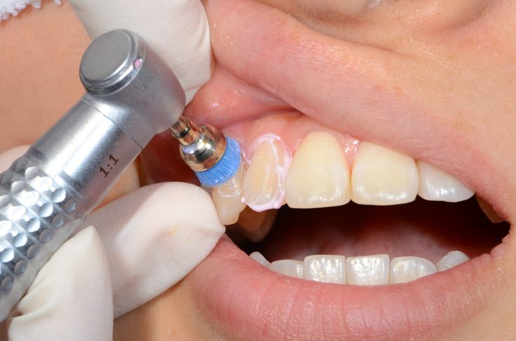 Scaling and Polishing Mild