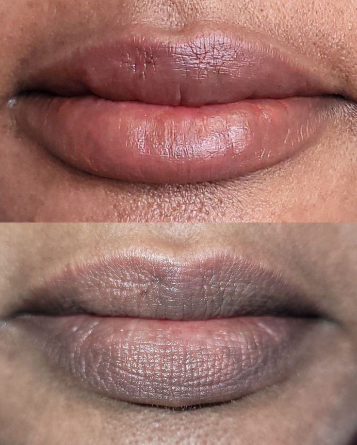 Dark Lip Neutralization