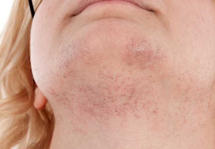 Women Chin Wax