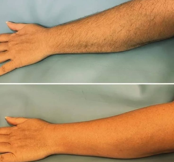 Men Full Arms Wax