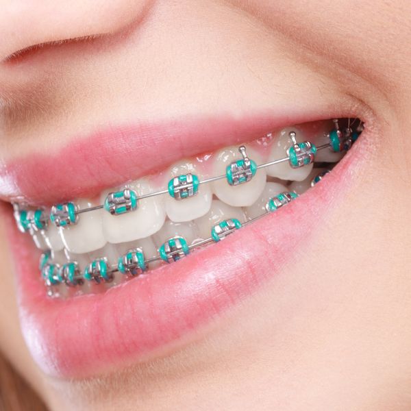 Fashion Braces