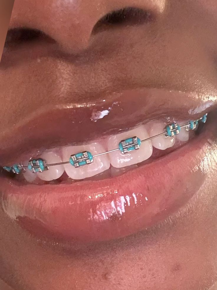 Fashion Braces