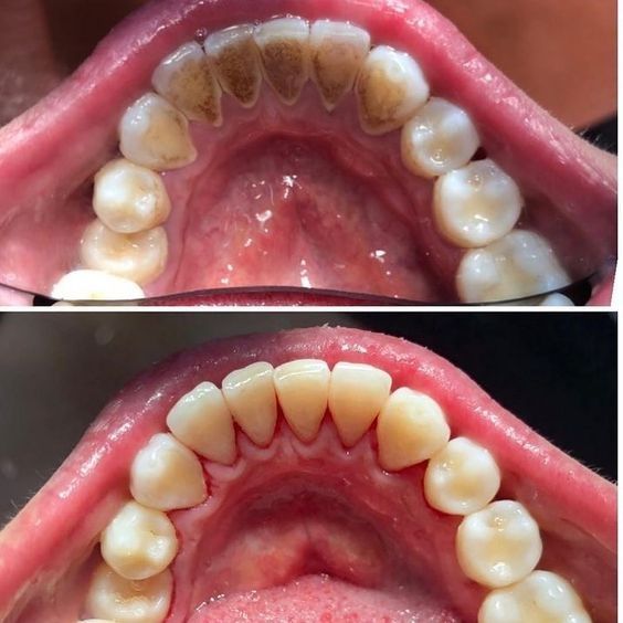 Scaling and Polishing Mild