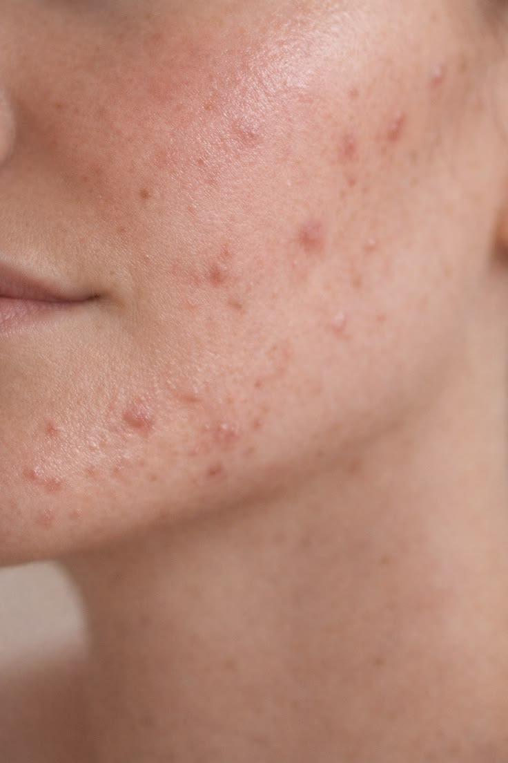 Acne Grade I Facial