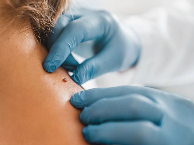 Skin Tag Removal Training