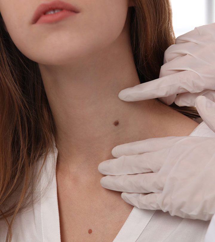 Skin Tag Removal Training