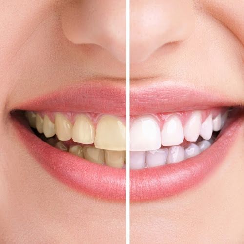 Premium Teeth Whitening