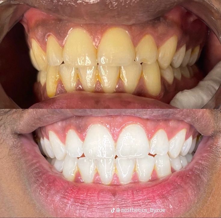 Pro Teeth Whitening