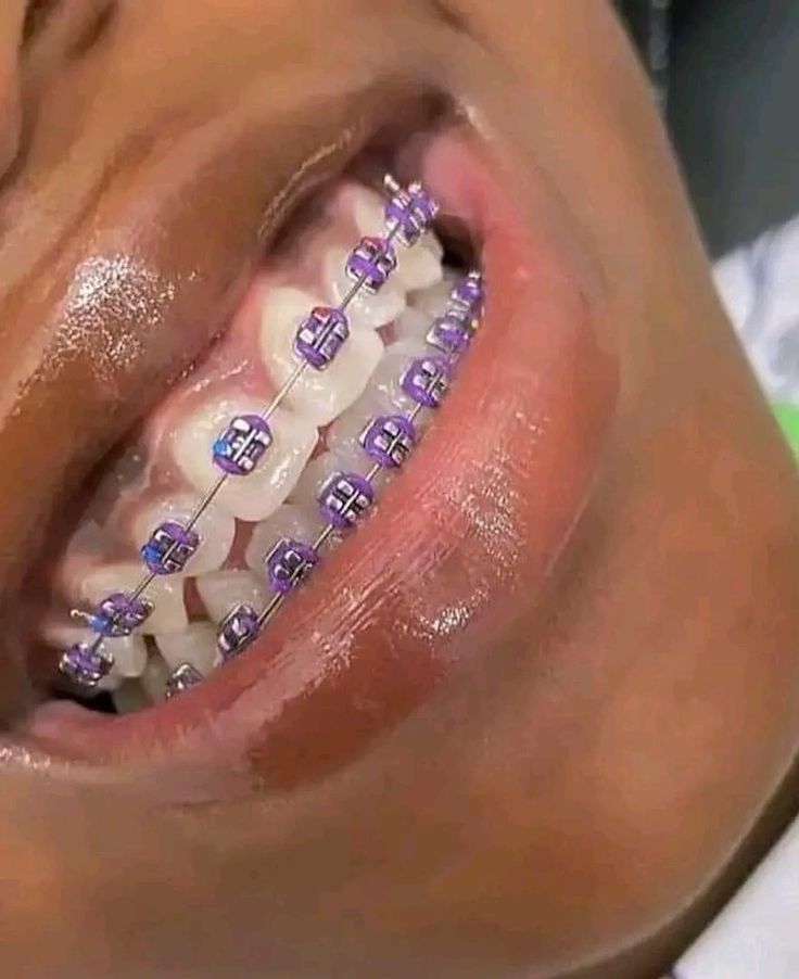 Fashion Braces