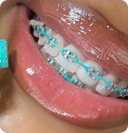 Power Chain Braces