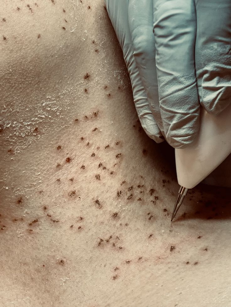Skin Tag Removal Training