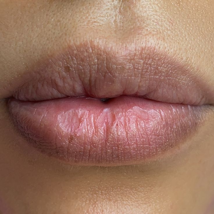 Dark Lip Neutralization