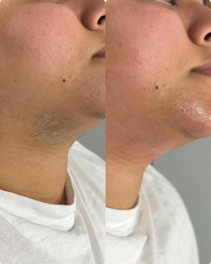 Men Upper Chin Wax